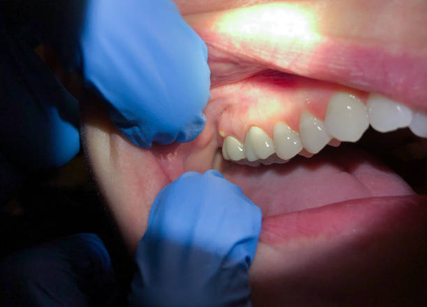 Best Chipped Tooth Repair Near Me  in Auberry, CA